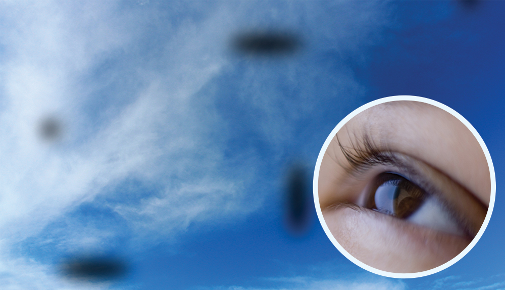 5 Things To Know About The Floaters In Your Eyes - This Quarterly